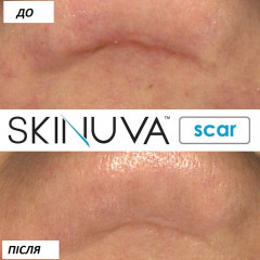 Крем для післяопераційних і побутових рубців Skinuva Next Generation Scar Cream 30 мл