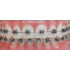 Брекети для вирівнювання зубів саморегулюючі Damon Q Ormco (США)