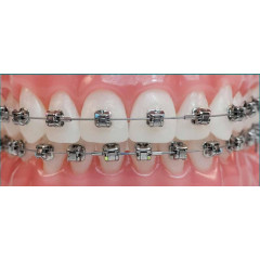 Self-ligating braces Damon Q Ormco (USA) for teeth alignment.