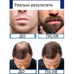 Чоловічий засіб Rogaine Extra Strength 5% для росту волосся з дерма-ролером