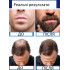 Rogaine Extra Strength men's hair growth product with minoxidil derma-roller